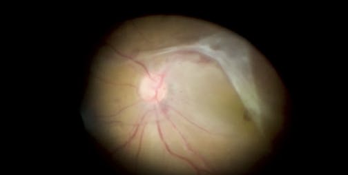 Double Peel of ERM and ILM for Severe Proliferative Diabetic Retinopathy