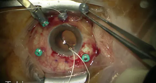 Scleral Fixation of an IOL Using Gore-Tex