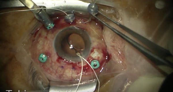 Scleral Fixation of an IOL Using Gore-Tex thumbnail