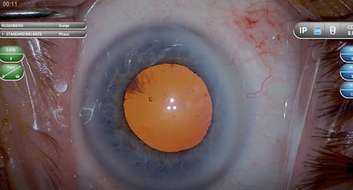Posterior Capsular Rupture