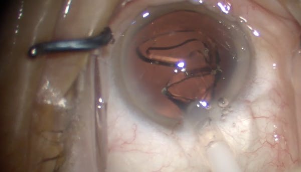 RayOne EMV Implantation thumbnail