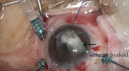 Anterior Hyaloid Visualization