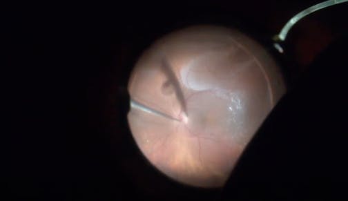 Iatrogenic Retinal Incarceration During Vitrectomy