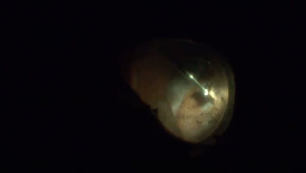 PVR Retinal Detachment With Hemorrhagic Choroidals and Hypotony thumbnail