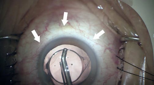 Blanching After Hydrus Implantation