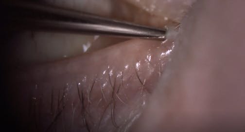 In-Office Administration of Dextenza