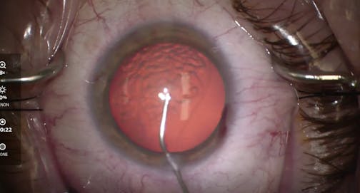ClearVisc Dispersive Viscoelastic During Cataract Surgery