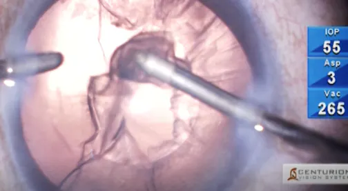 Cortical Aspiration: The POPS Technique