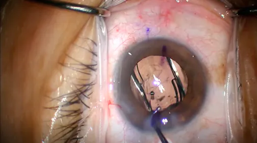 Synergy Toric IOL Implantation