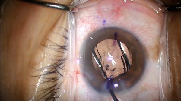 Synergy Toric IOL Implantation thumbnail