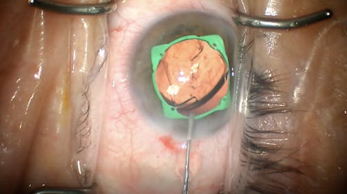 Synergy Toric IOL Implantation With Pupil Expander