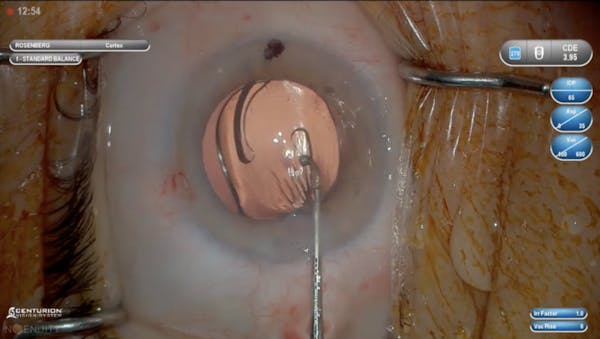 3D Visualization of Combination PanOptix IOL and iStent Implantation thumbnail
