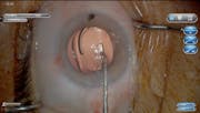 3D Visualization of Combination PanOptix IOL and iStent Implantation