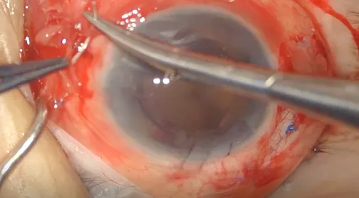 Scleral Fixation of an IOL