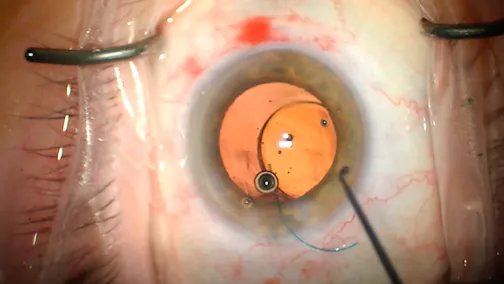 Implantation of Light Adjustable Lens