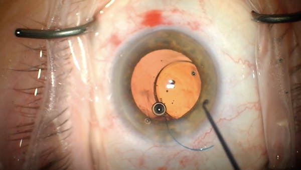 Implantation of Light Adjustable Lens thumbnail