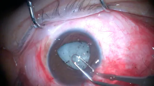 ICL Explantation in Eye With Small Pupil