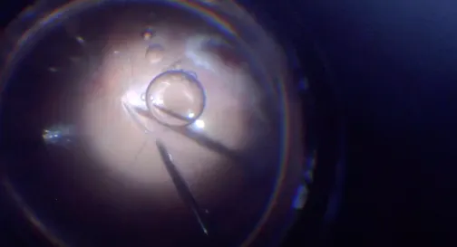 Retinal Detachment With PVR