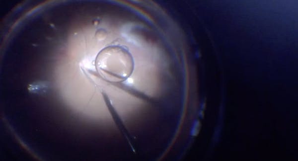 Retinal Detachment With PVR thumbnail