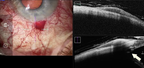 Rescan Intraoperative OCT: iTrack Canaloplasty