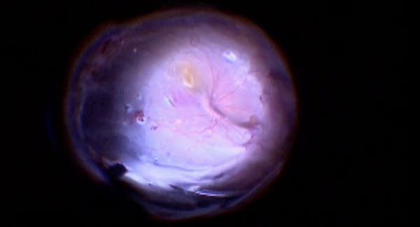 Combined Tractional/Rhegmatogenous Retinal Detachment Repair in the Setting of Uveitis thumbnail
