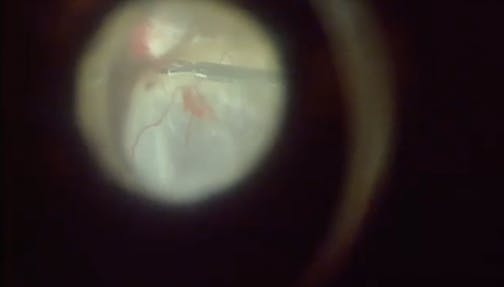Subretinal Infusion During Atypical Retinal Detachment Repair