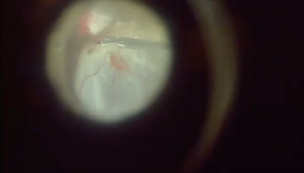 Subretinal Infusion During Atypical Retinal Detachment Repair thumbnail