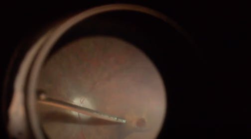 Traumatic Macular Hole