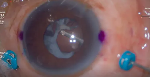 Pars Plana Lensectomy for Traumatic Cataract With Resorbed Nucleus