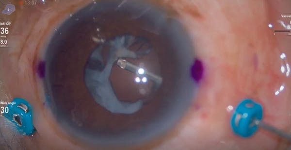 Pars Plana Lensectomy for Traumatic Cataract With Resorbed Nucleus thumbnail