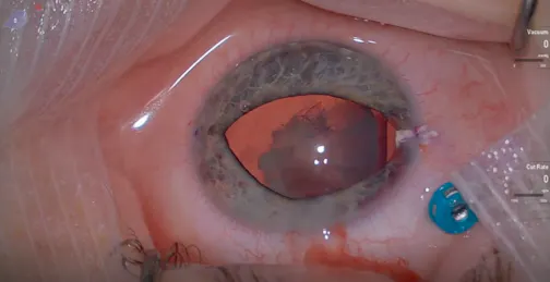 Management of Zonular Dialysis in Cataract Surgery