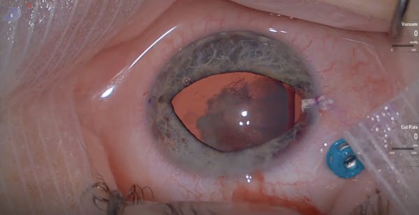 Management of Zonular Dialysis in Cataract Surgery thumbnail