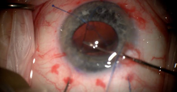IOL Punch and Rescue thumbnail