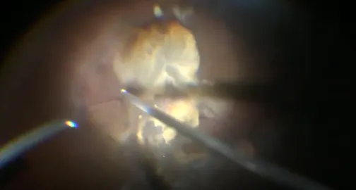 25-Gauge Vitrectomy for Advanced Active Proliferative Diabetic Retinopathy
