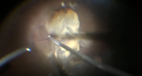 25-Gauge Vitrectomy for Advanced Active Proliferative Diabetic Retinopathy thumbnail