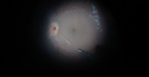 Severe Blunt Eye Trauma With Corneal Laceration and Foveal Sparing Posterior Scleral Rupture