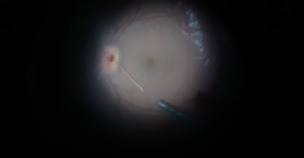 Severe Blunt Eye Trauma With Corneal Laceration and Foveal Sparing Posterior Scleral Rupture thumbnail