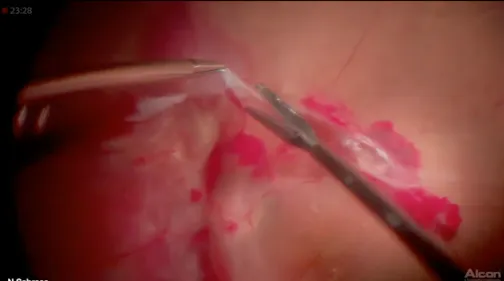 Bimanual Vitreoretinal Surgery for Tractional Retinal Detachment Due to Proliferative Diabetic Retinopathy