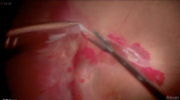 Bimanual Vitreoretinal Surgery for Tractional Retinal Detachment Due to Proliferative Diabetic Retinopathy thumbnail
