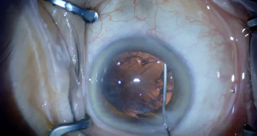 Cortical Cleaving Viscodissection