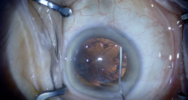 Cortical Cleaving Viscodissection thumbnail
