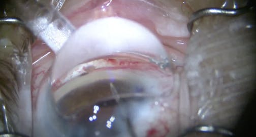 Laser Cataract Surgery Combined With iTrack Canaloplasty and Hydrus Microstent