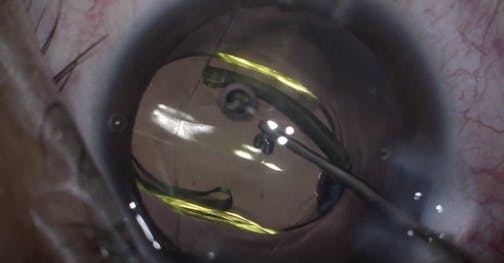 Balloon Intumescent Cataracts