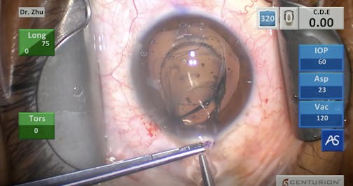 Femtosecond Laser With ICL Removal