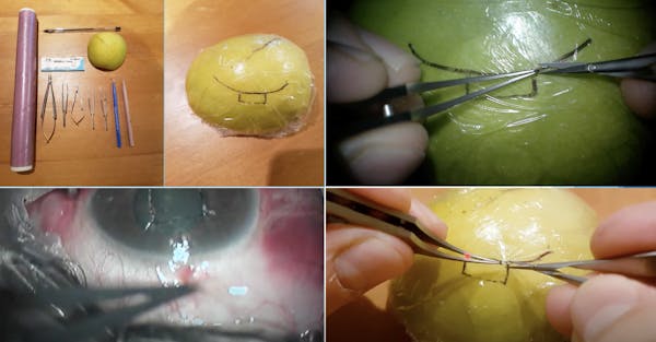 Practicing Trabeculectomy Surgery on an Apple thumbnail