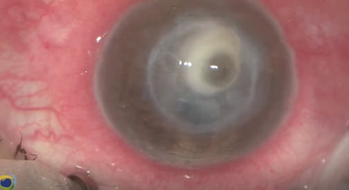 Penetrating Keratoplasty and Cataract Extraction