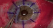 Planned DSAEK Converted to Penetrating Keratoplasty