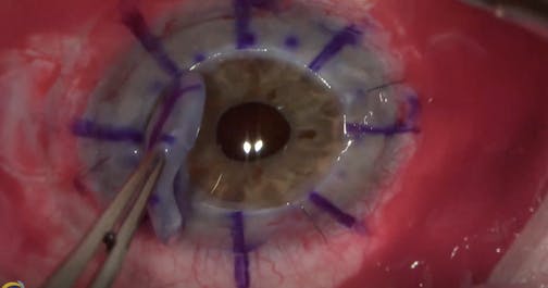 Planned DSAEK Converted to Penetrating Keratoplasty