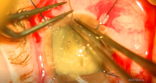 Subluxated Cataract