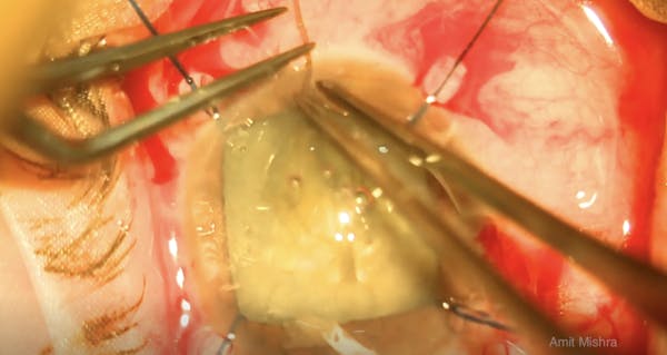 Subluxated Cataract thumbnail